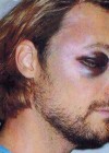 Gabriel Aubry’s Battered & Bruised Face After Fight with Olivier Martinez