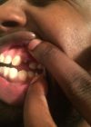 Desmond Marrow Injury (Knocked Out Teeth) After Arrest