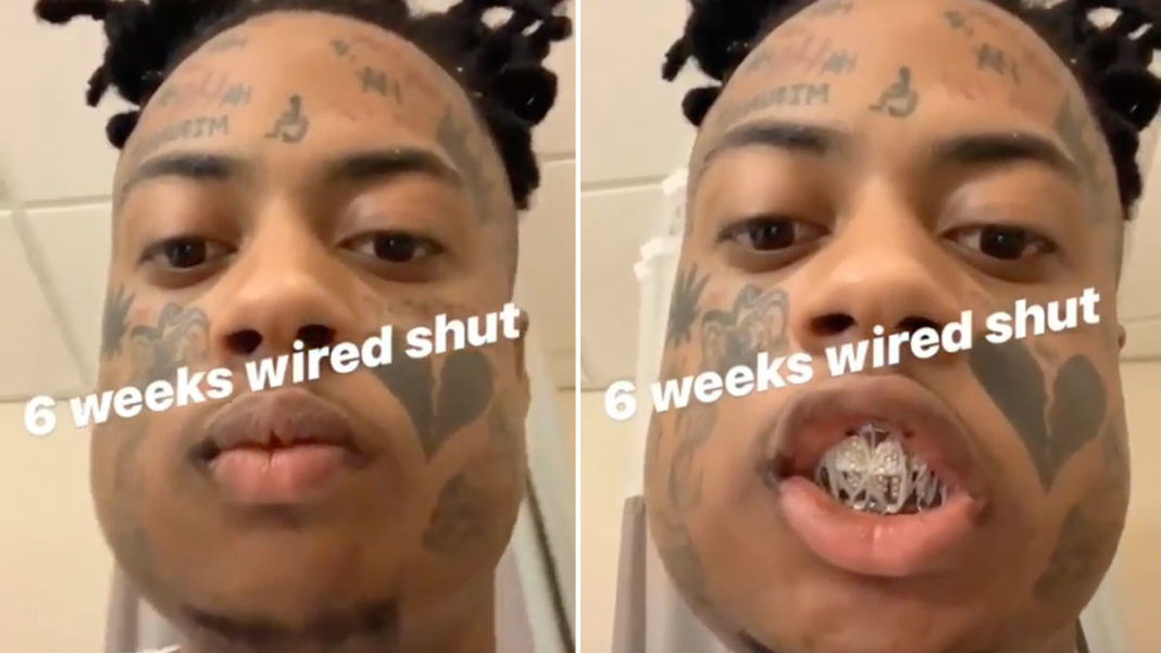 Boonk Gang Says His Jaw Will Be Wired Shut For 6 Weeks After Getting